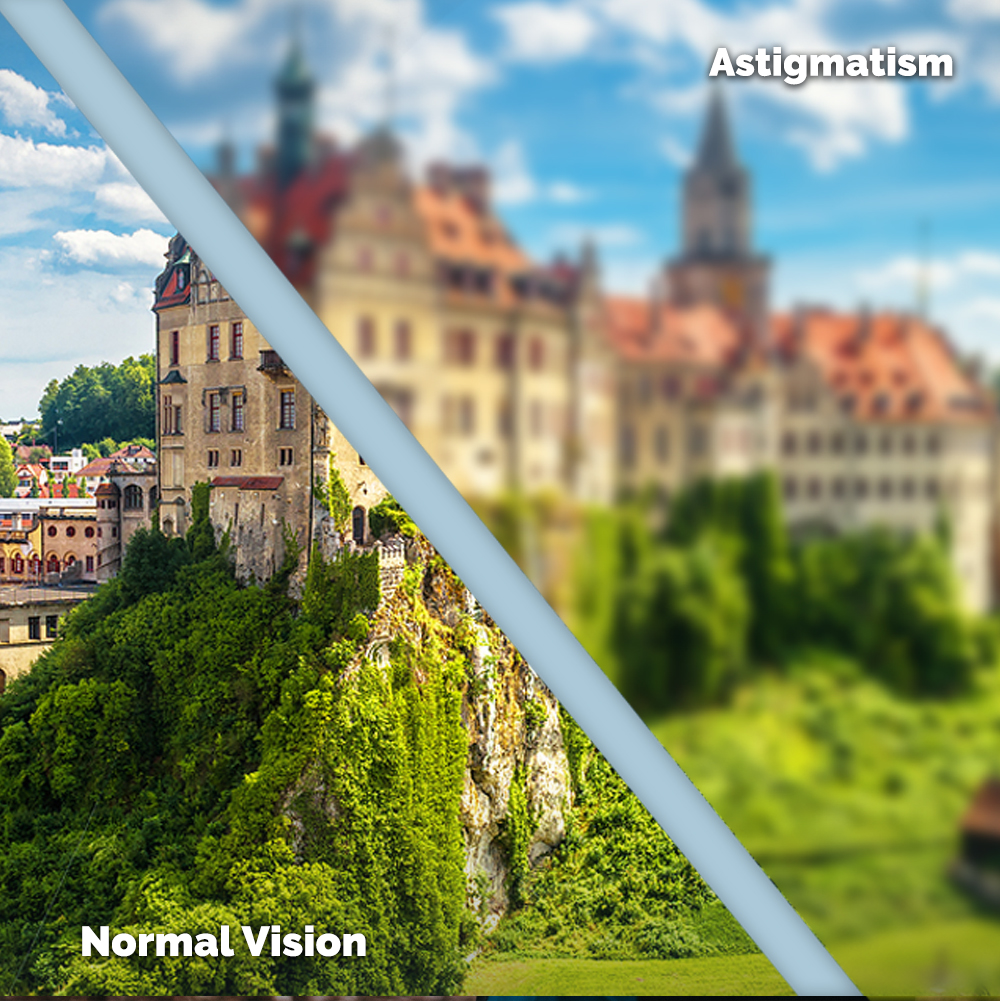 Astigmatism Treatment in Erie